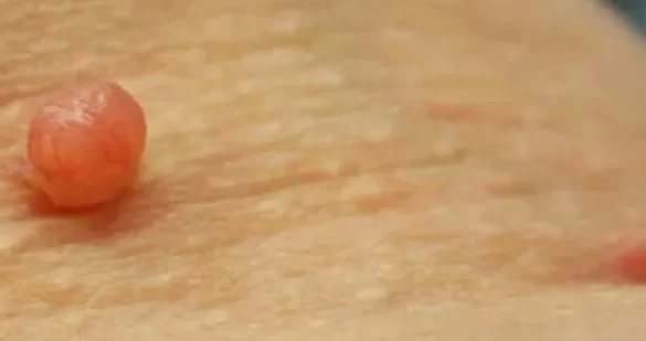 et beni nasil giderilir 1