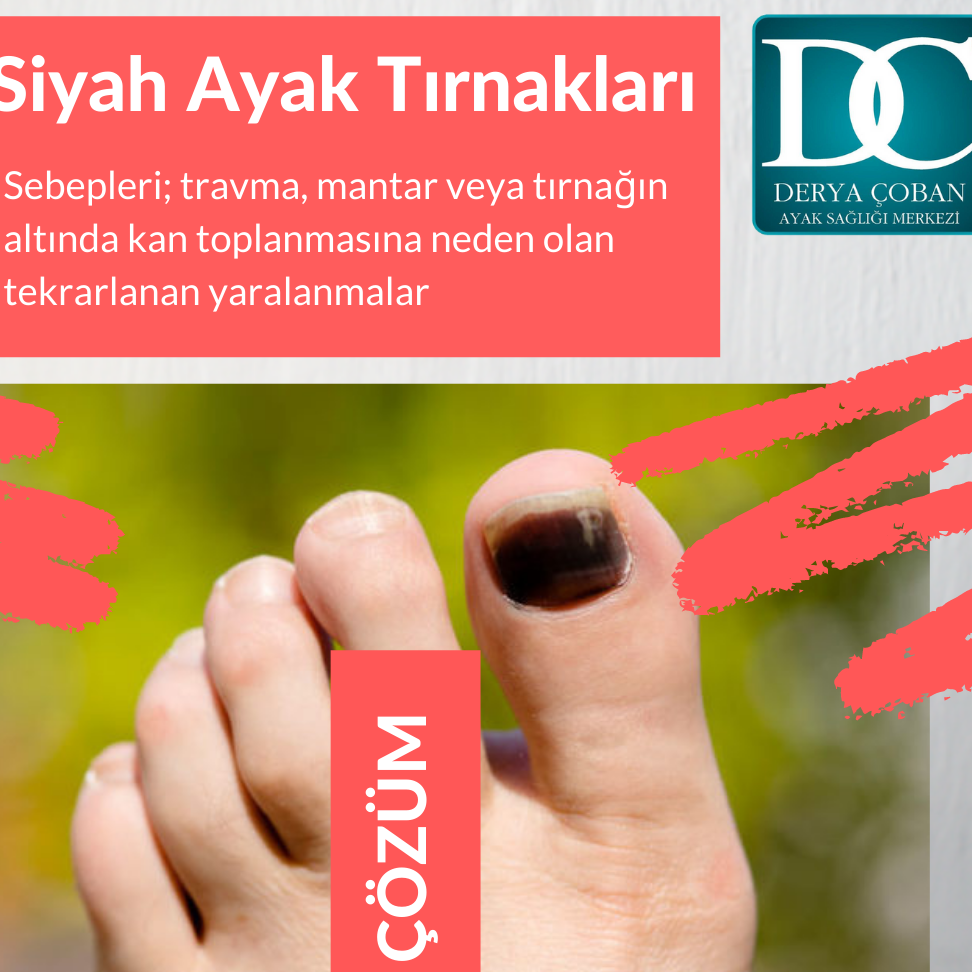 siyah ayak tirnagi nasil tedavi edilir